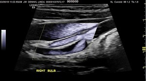 stenosis01-start-image.jpg