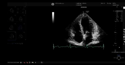  LOGIQ E10 - Cardiac 