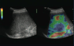 LOGIQ E10 - SWE Elastography