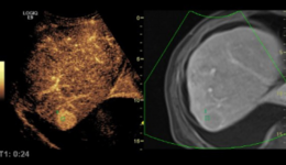 LOGIQ E9 XDclear 2.0 Benefits of Liver Ablation Over Liver ...