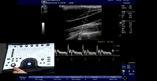 LOGIQ e - Pulsed Doppler controls