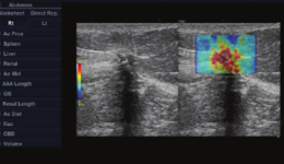 LOGIQ E9 - SWE Breast Imaging