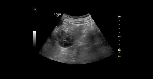 Dr. Weskott - How and Why to Use CEUS for Kidney Studies 